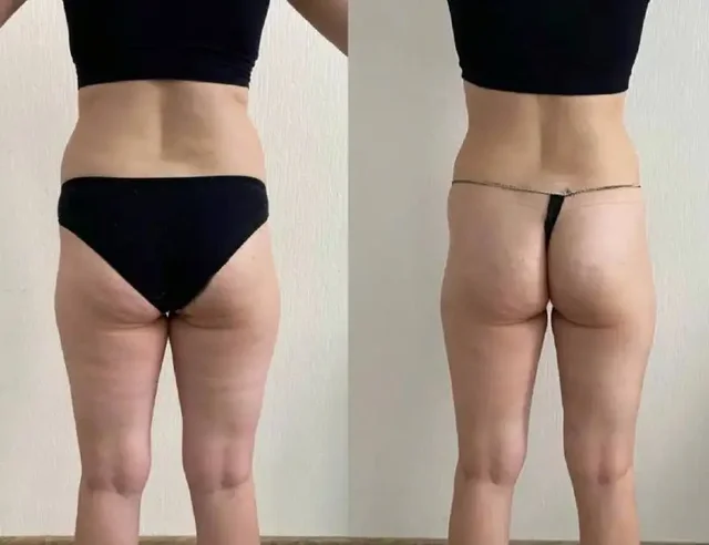 Курс процедур для похудения к лету - Услуги по коррекции фигуры в Екатеринбург