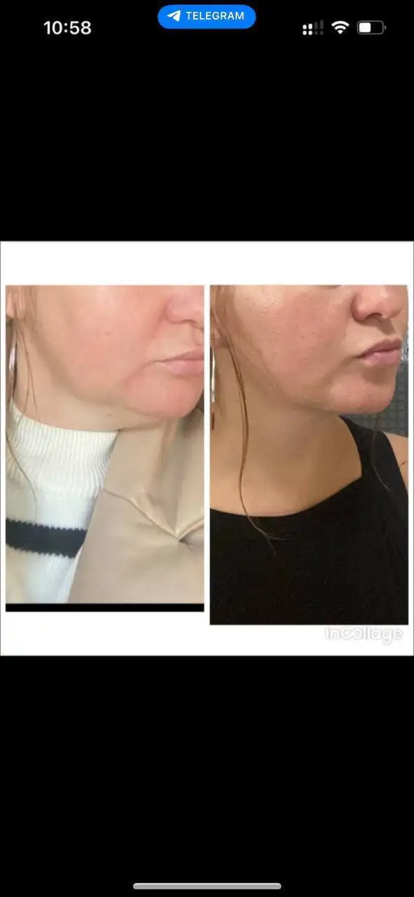 Аппаратная коррекция фигуры 25 процедур - Услуги в Екатеринбург