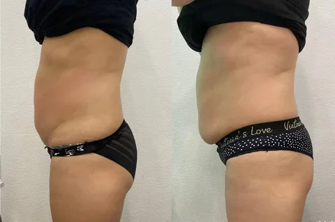 Аппаратная коррекция фигуры: 25 процедур тело и лицо - Оформление праздников в Екатеринбург