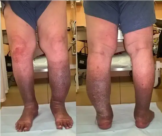 Информация о диабете и его влиянии на ноги - Информационные материалы (Барахолка) в Уфа