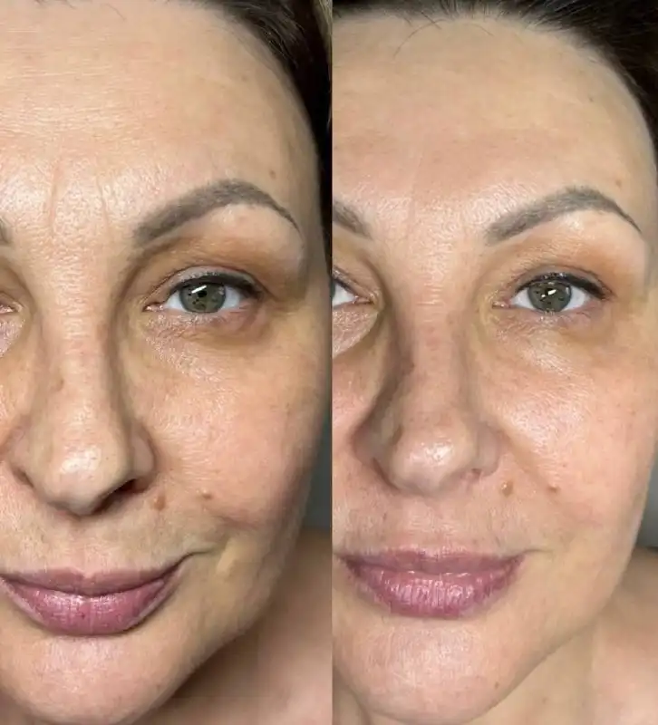 Комплекс 'AuraLift' для лица