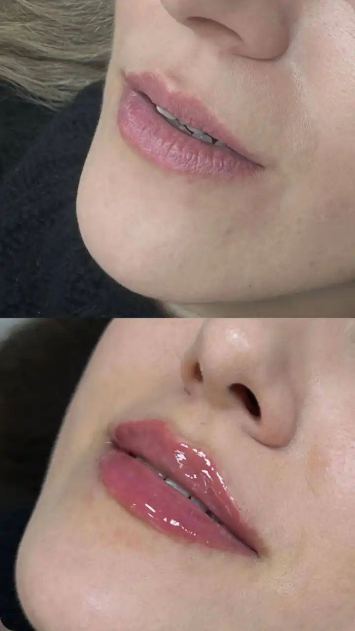 Увеличение губ