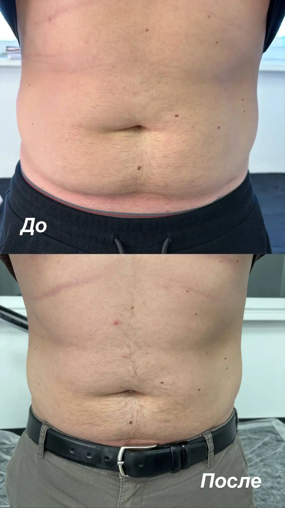 Липолитики