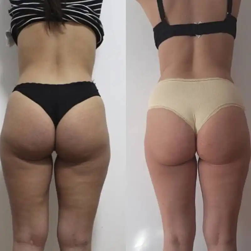 Экспресс моделирование: турбомассажи тела с обертываниями