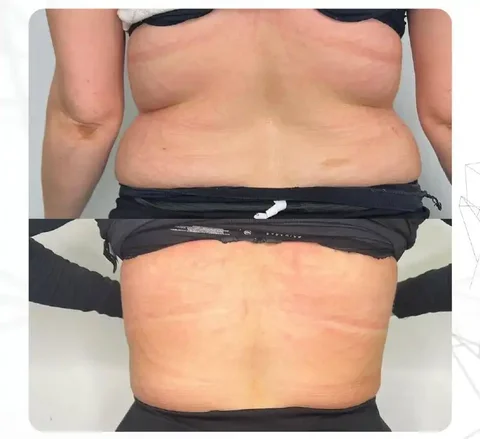 Услуги липолитиков в Сургуте - Косметика в Сургут