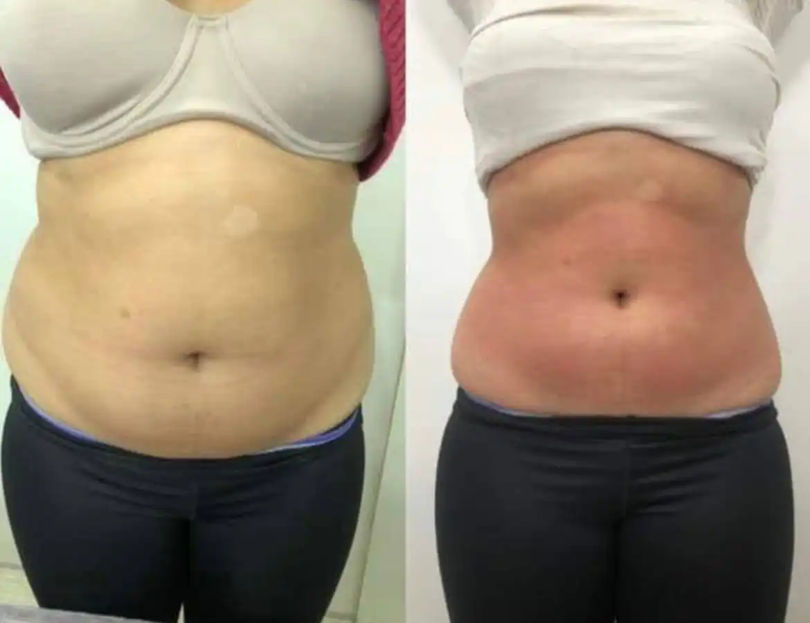 10 турбомассажей тела с подарками - Массаж (Услуги) в Сургут