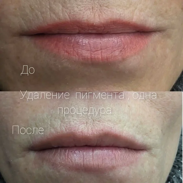 Удаление татуировок и перманента - Кулинария в Сургут