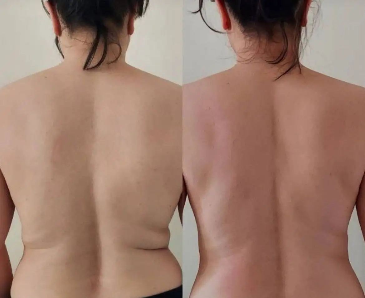 LPG-массаж с новой 3D манипулой - Красота и здоровье (Услуги) в Сургут