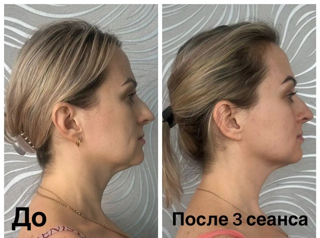 Сеансы витапластики