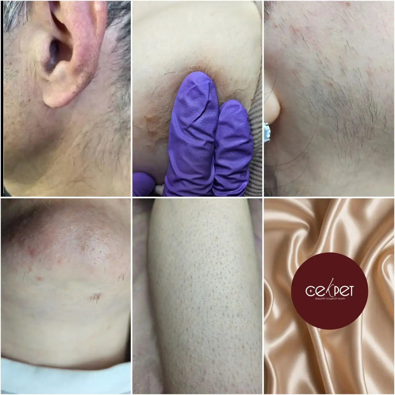 Электроэпиляция в Краснодаре