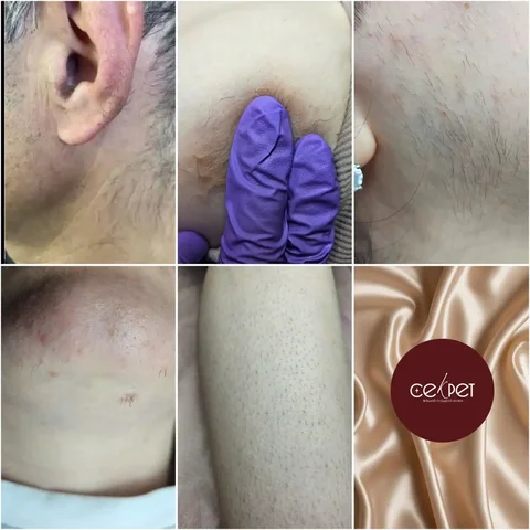 Электроэпиляция в Краснодаре - Красота и здоровье в Краснодар