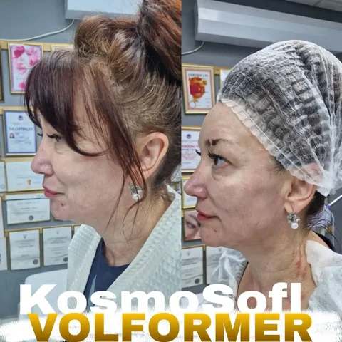 Протокол VOLFORMER от двух топ-аппаратов Volnewmer и Ultraformer Mpt - Работа в Краснодар