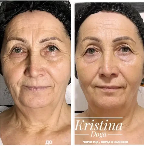 Процедура омоложения лица холодной плазмой - частное объявление в Краснодар