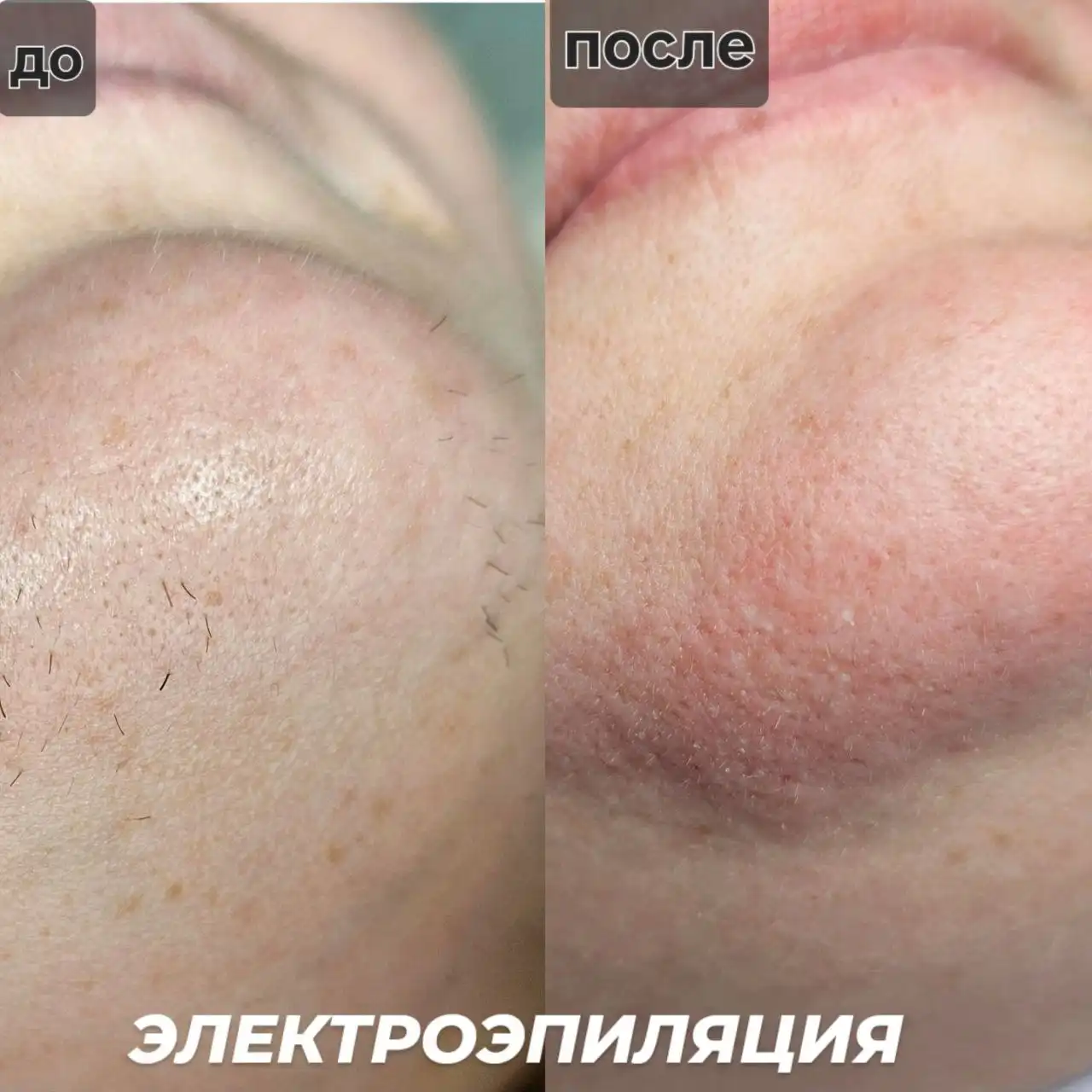 Электроэпиляция любой зоны - Эпиляция (Красота и здоровье) в Краснодар