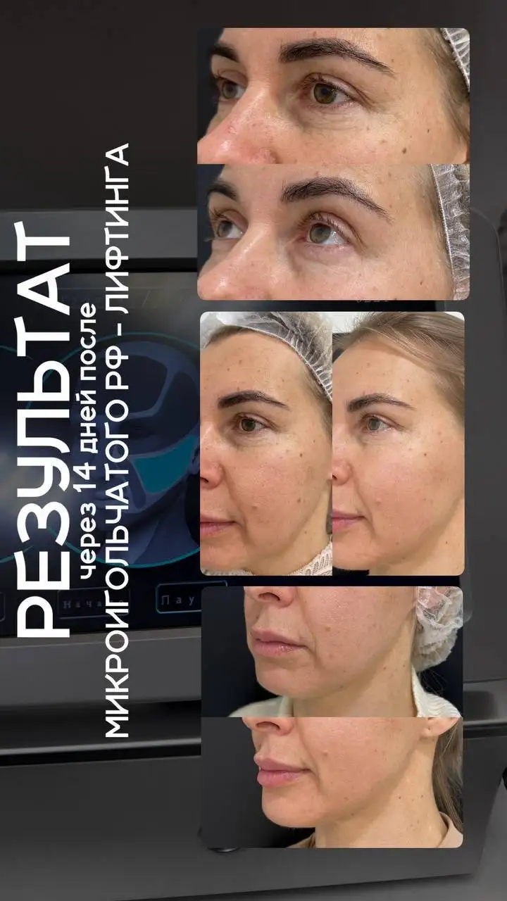 Игольчатый РФ-лифтинг лица и шеи - Кулинария/Кондитерские изделия в Краснодар