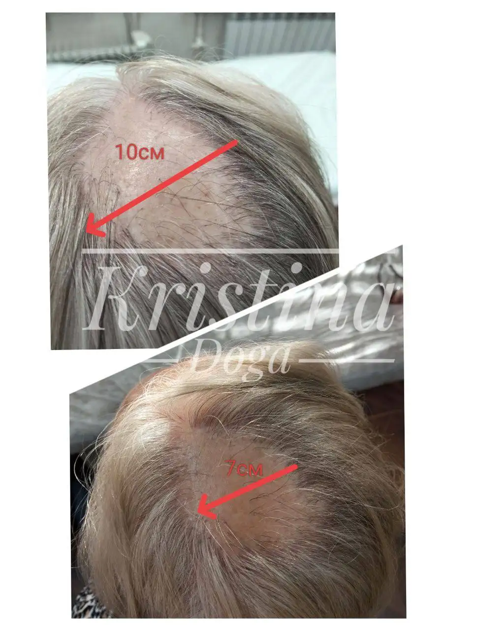 Восстановление волос и омоложение лица холодной плазмой - Косметология (Услуги) в Краснодар