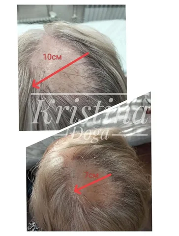 Восстановление волос и омоложение лица холодной плазмой - частное объявление в Краснодар