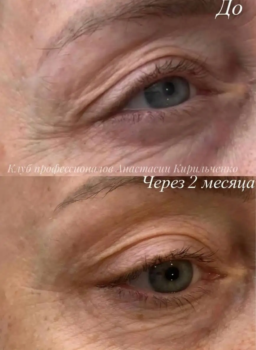 Блефаропластика без скальпеля и омоложение холодной плазмой - Косметология (Красота и здоровье) в Краснодар