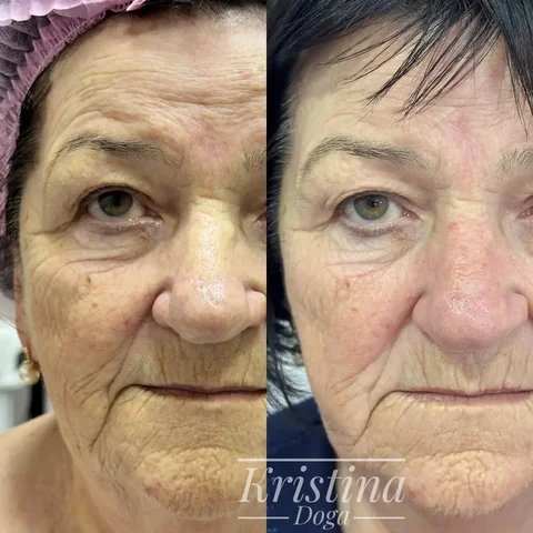 Курс массажа и плазмы для омоложения лица - Химчистка/Стирка в Краснодар