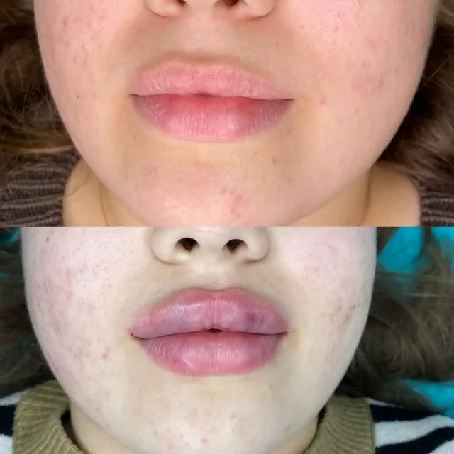 Естественная коррекция формы губ у косметолога в Краснодаре - Подготовка недвижимости в Краснодар