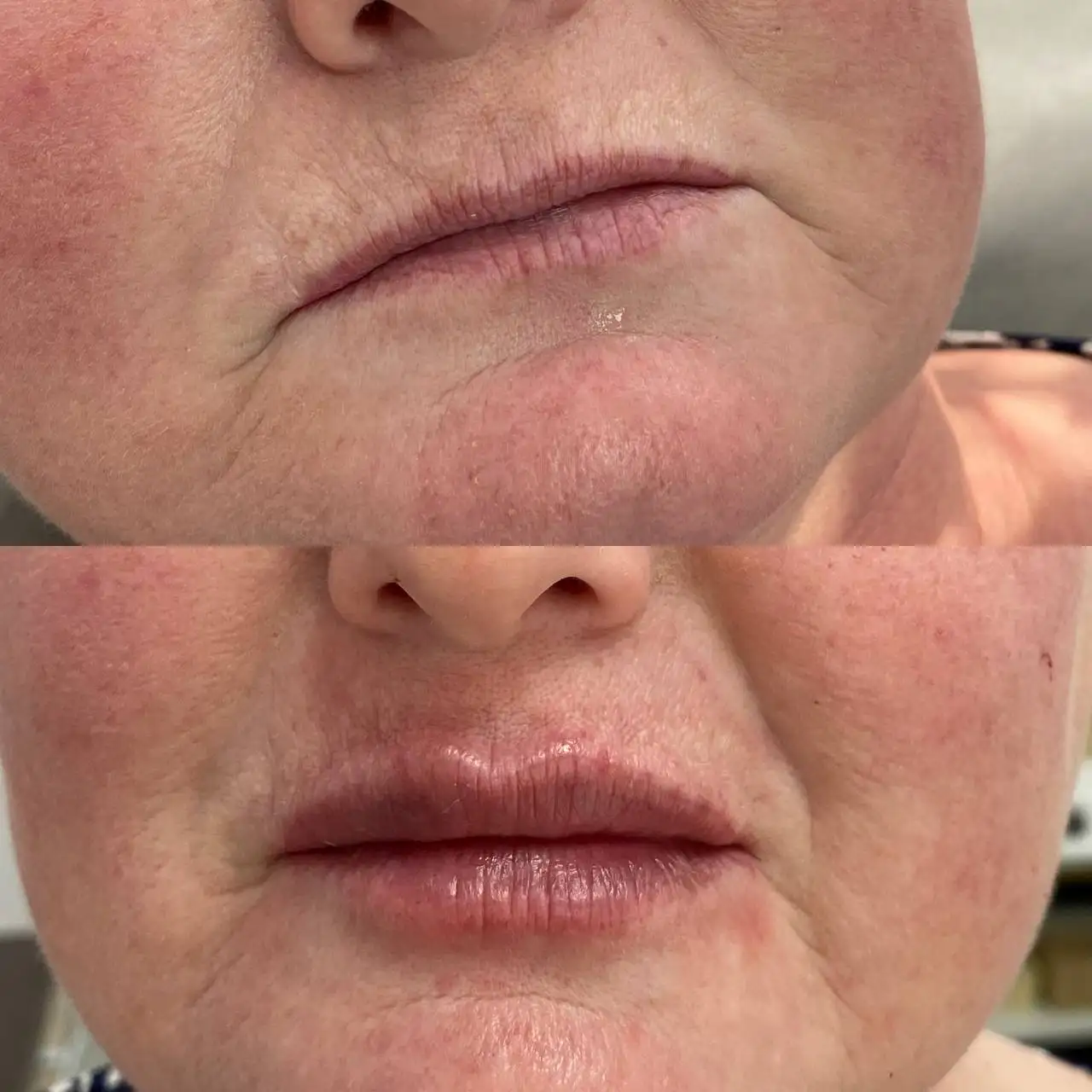 Естественная коррекция формы губ у косметолога в Краснодаре - Косметология (Услуги) в Краснодар