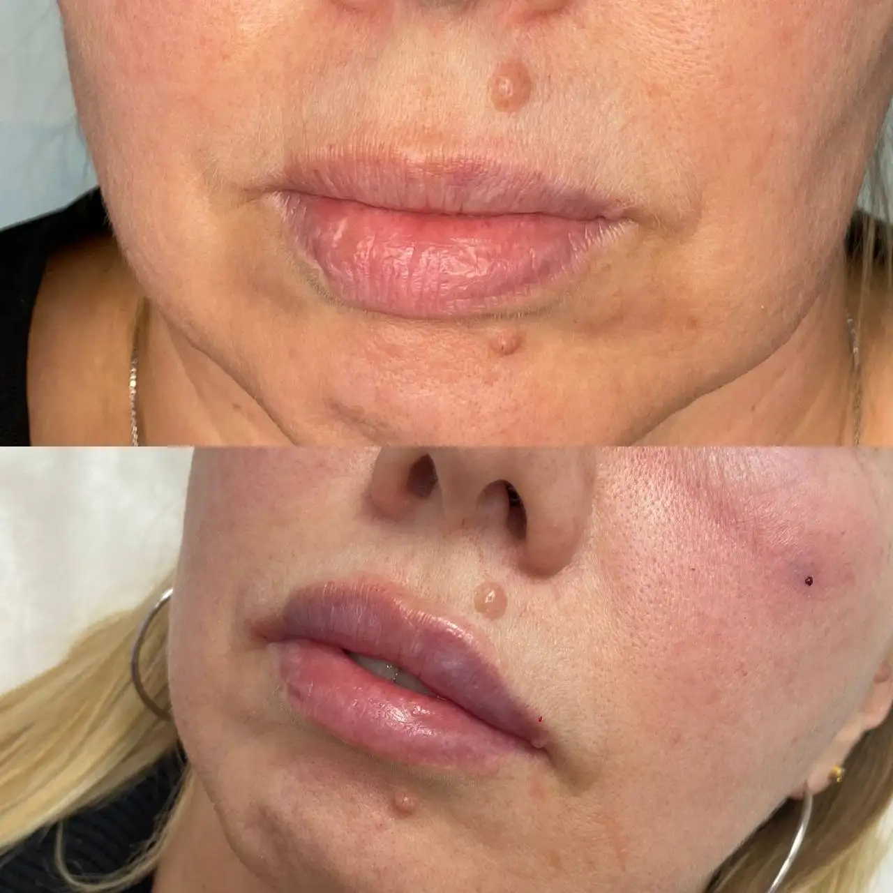 Естественная коррекция формы губ у косметолога в Краснодаре - Косметология (Услуги) в Краснодар