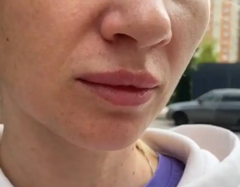 Естественная коррекция формы губ у косметолога в Краснодаре - Косметология (Услуги) в Краснодар