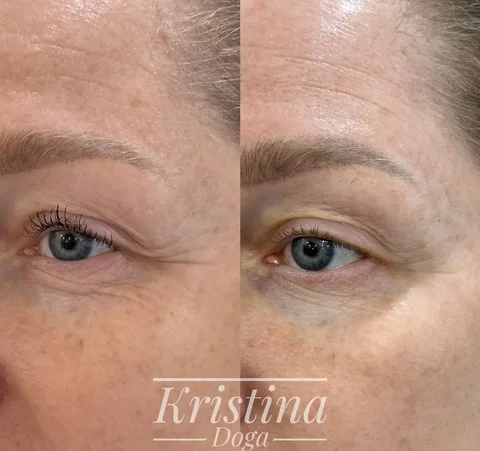 Процедура холодной плазмы для омоложения лица - Работа в Краснодар