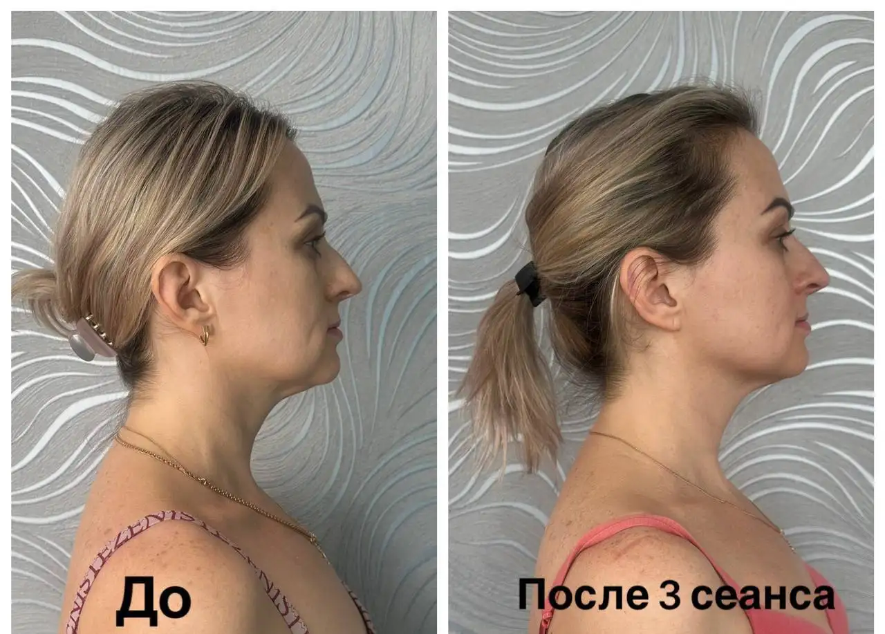 Сеансы витапластики в Краснодаре - Косметология (Услуги) в Краснодар