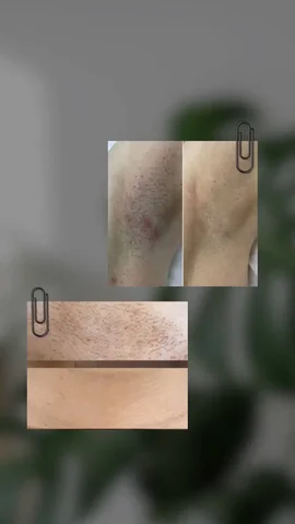 Услуги лазерной эпиляции в Краснодаре - Лазерная эпиляция в Краснодар