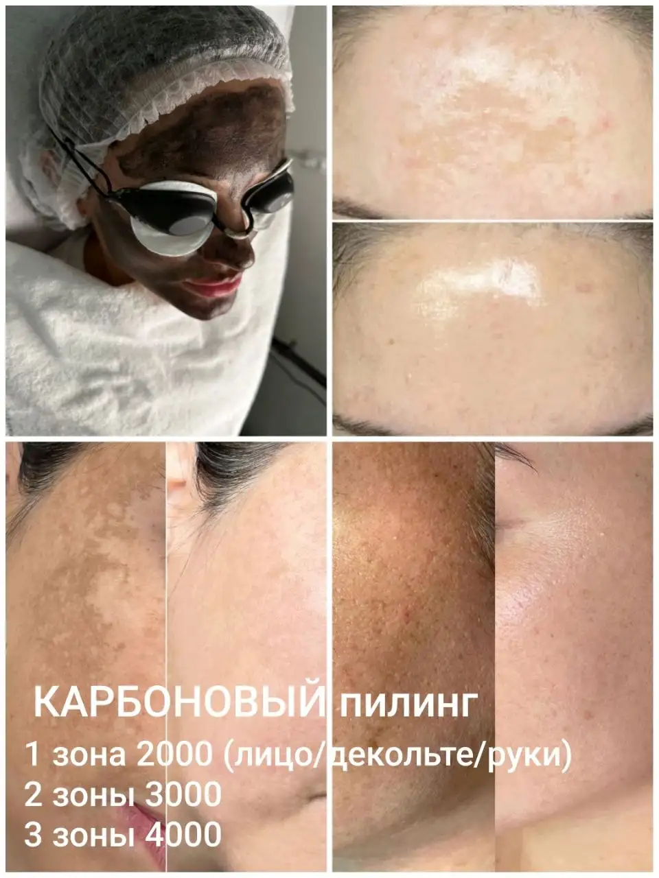 Карбоновый пилинг – эффект фарфоровой кожи - Косметология (Красота и здоровье) в Краснодар