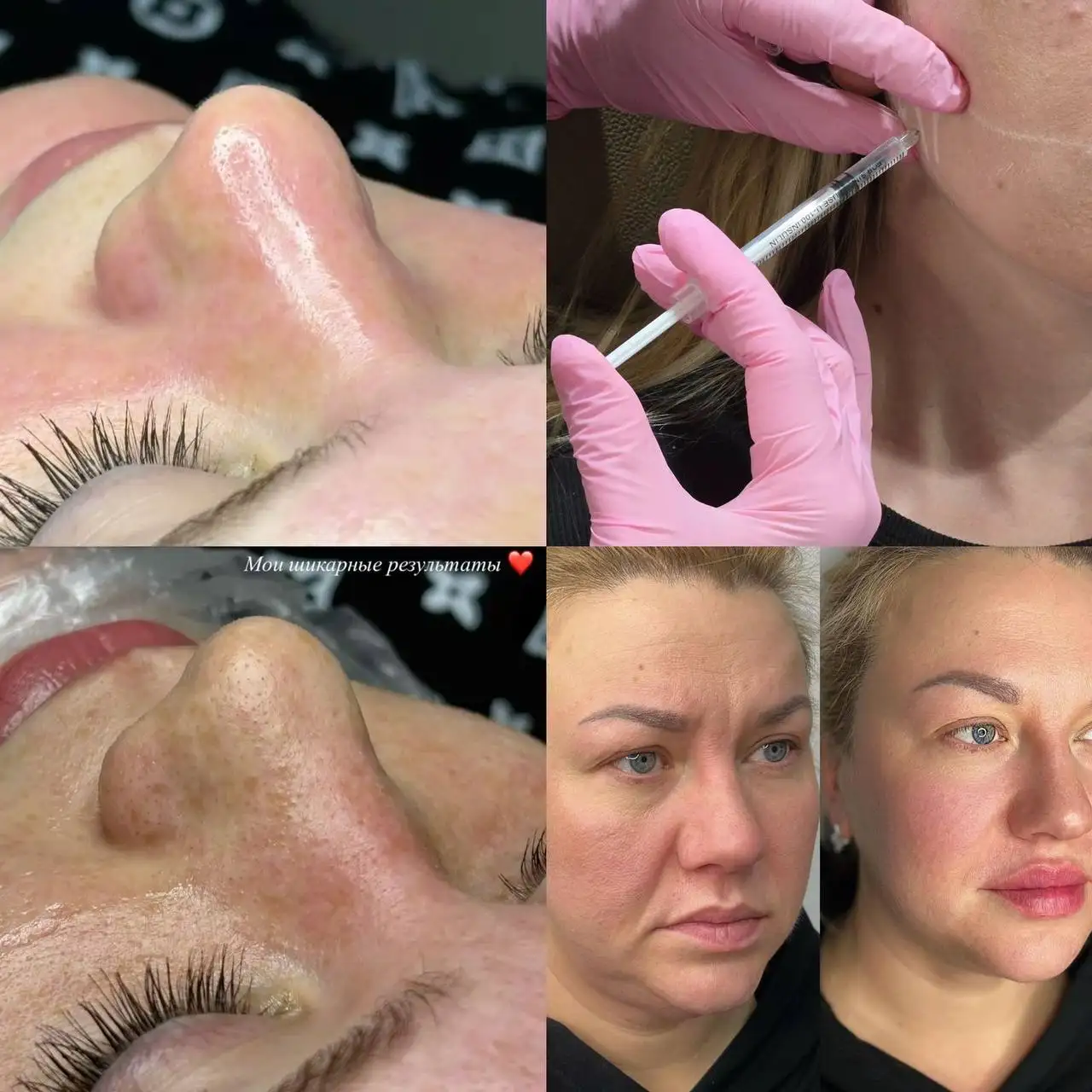 Косметологические услуги: уколы красоты и прокол ушей - Косметология (Красота и здоровье) в Краснодар