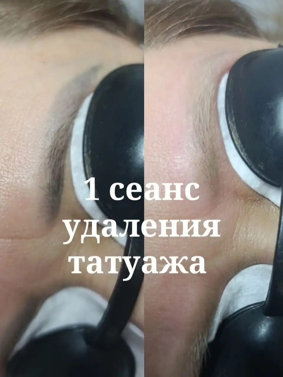 Удаление тату и перманентного макияжа, карбоновый пилинг - Удаление тату (Услуги) в Краснодар