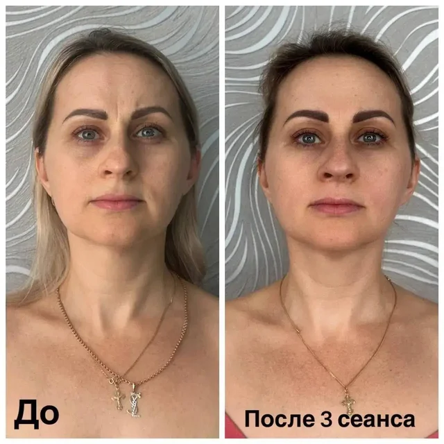 Витапластика - ручной метод омоложения лица и шеи - Косметология в Краснодар
