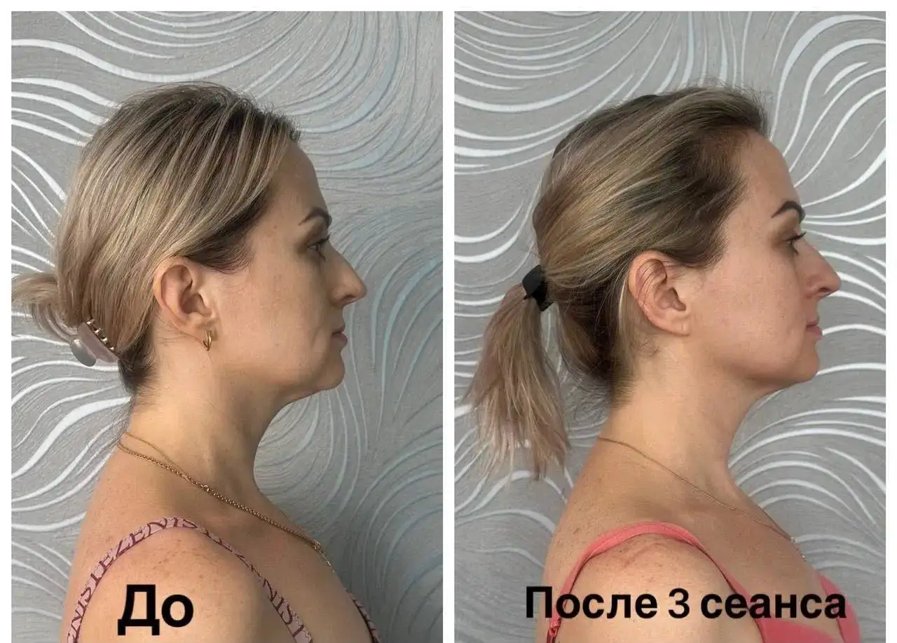 Витапластика - ручной метод омоложения лица и шеи - Витапластика (Красота и здоровье) в Краснодар