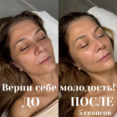 Аппаратный массаж лица - 3 услуги в 1 сеансе - Аренда бани в Иркутск