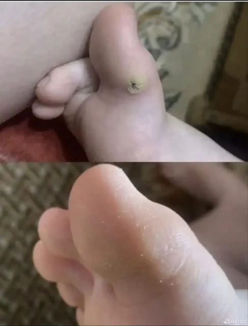 Мазь от шипиц, подошвенных бородавок, грибка ногтей - Красота и здоровье в Барнаул