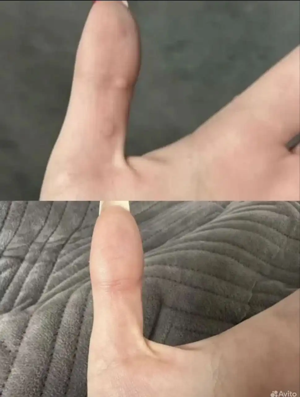 Мазь от шипиц, подошвенных бородавок, грибка ногтей