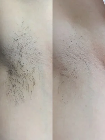 Курс электроэпиляции у сертифицированного мастера - Автоуслуги в Чебоксары