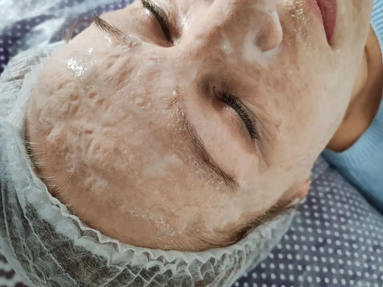 Процедуры чистка лица, энзимный пилинг, карбокситерапия