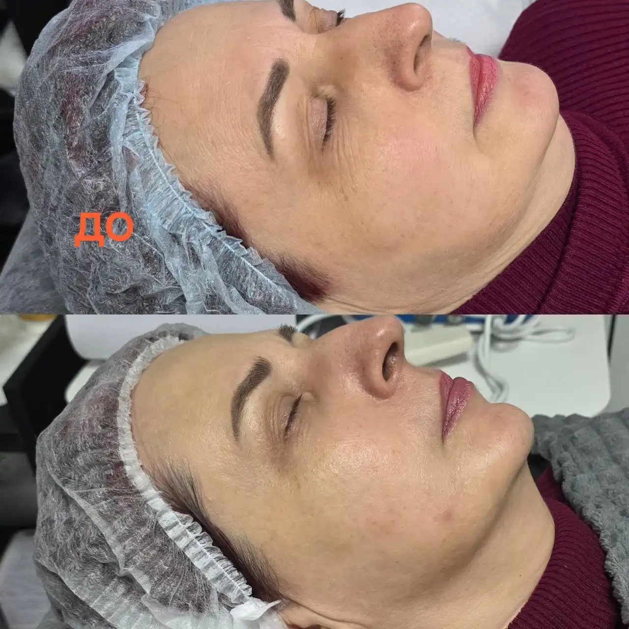 Процедуры чистка лица, энзимный пилинг, карбокситерапия