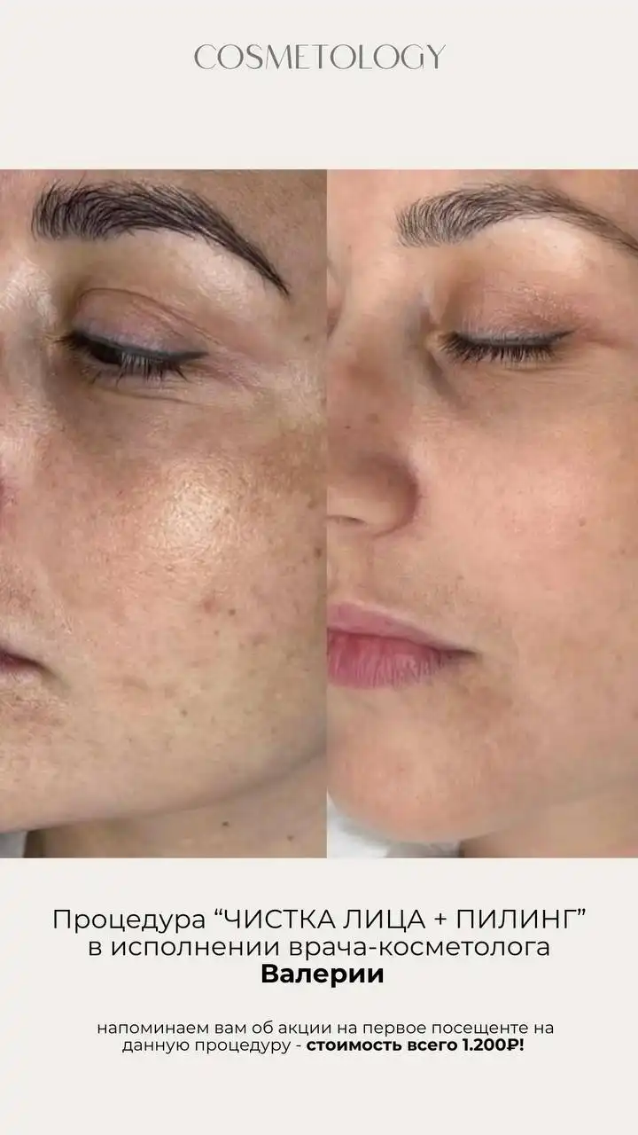 Акции января у врача-косметолога Валерии - Косметология (Красота и здоровье) в Ульяновск