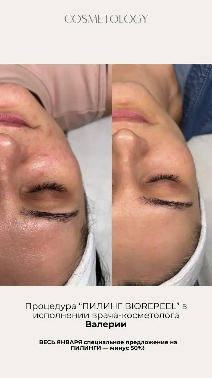 Акции января у врача-косметолога Валерии - Косметология (Красота и здоровье) в Ульяновск