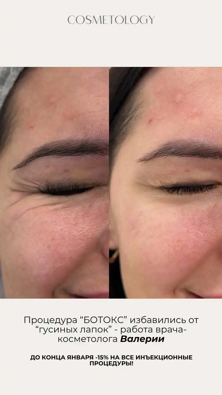 Акции января у врача-косметолога Валерии - Косметология (Красота и здоровье) в Ульяновск