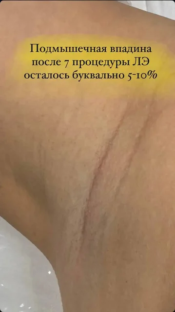 Лазерная эпиляция - свободные окна - Лекарства в Ульяновск