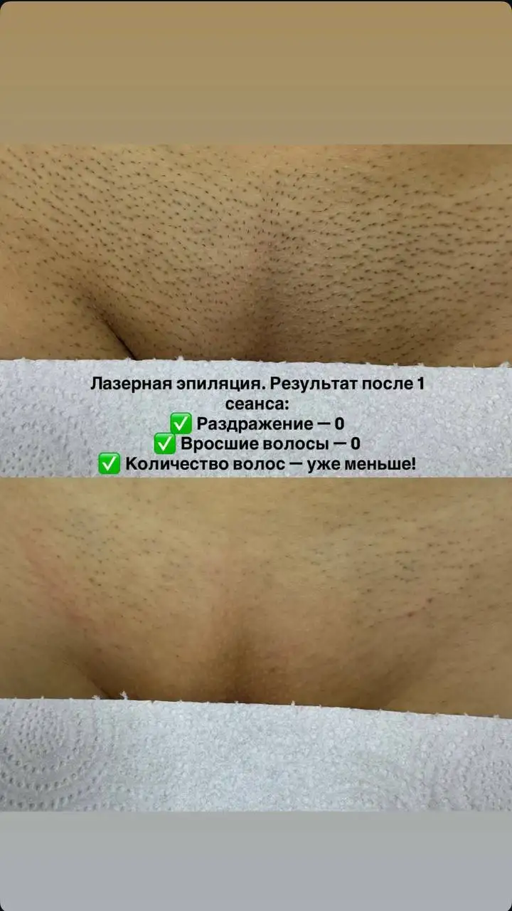 Лазерная эпиляция - свободные окна - Эпиляция (Красота и здоровье) в Ульяновск