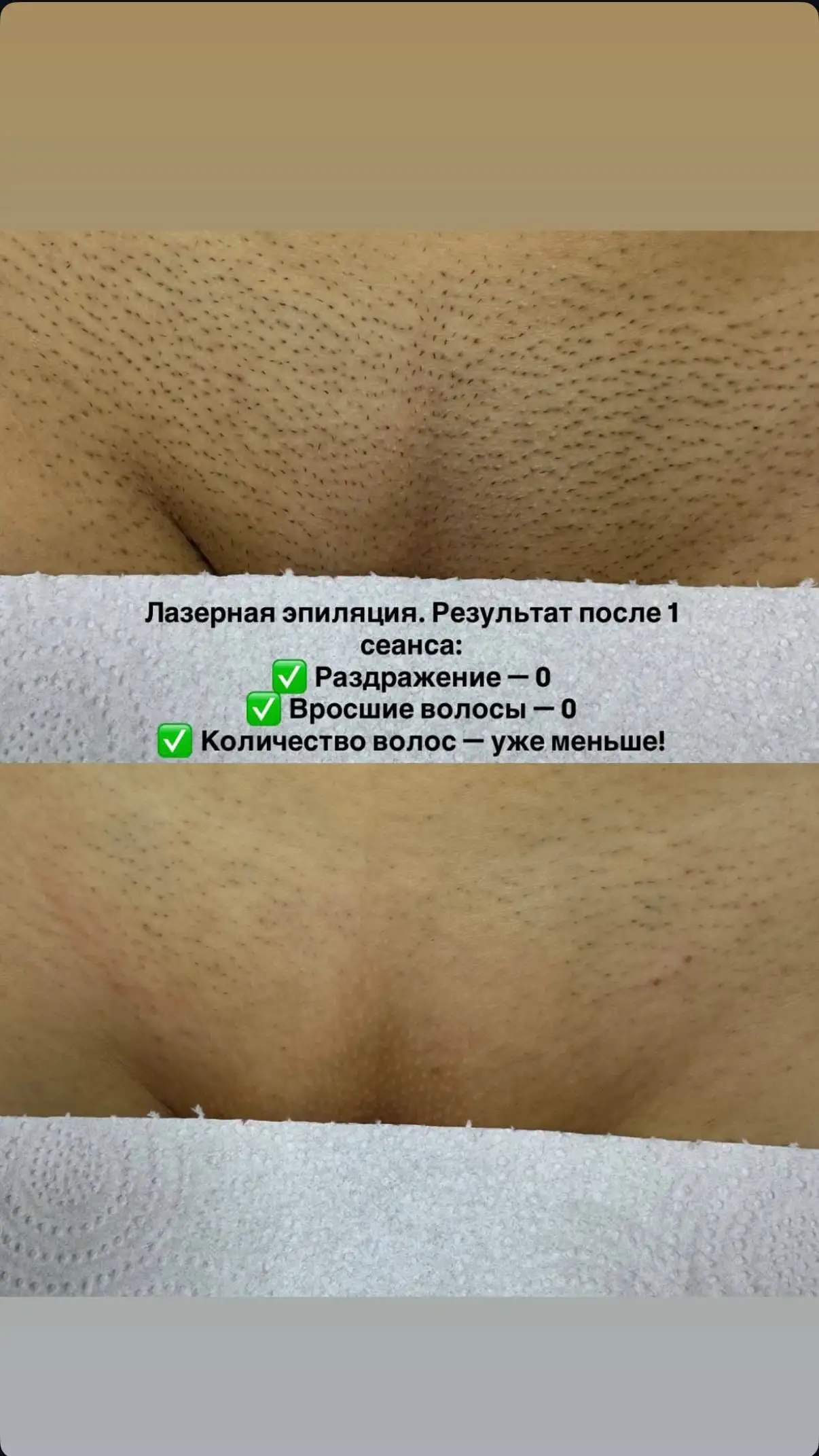 Лазерная эпиляция со скидкой 30% - Эпиляция (Красота и здоровье) в Ульяновск