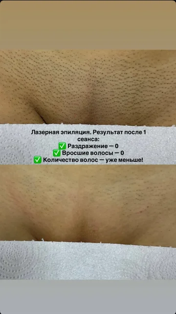 Лазерная эпиляция со скидкой 30% - Красота и здоровье в Ульяновск