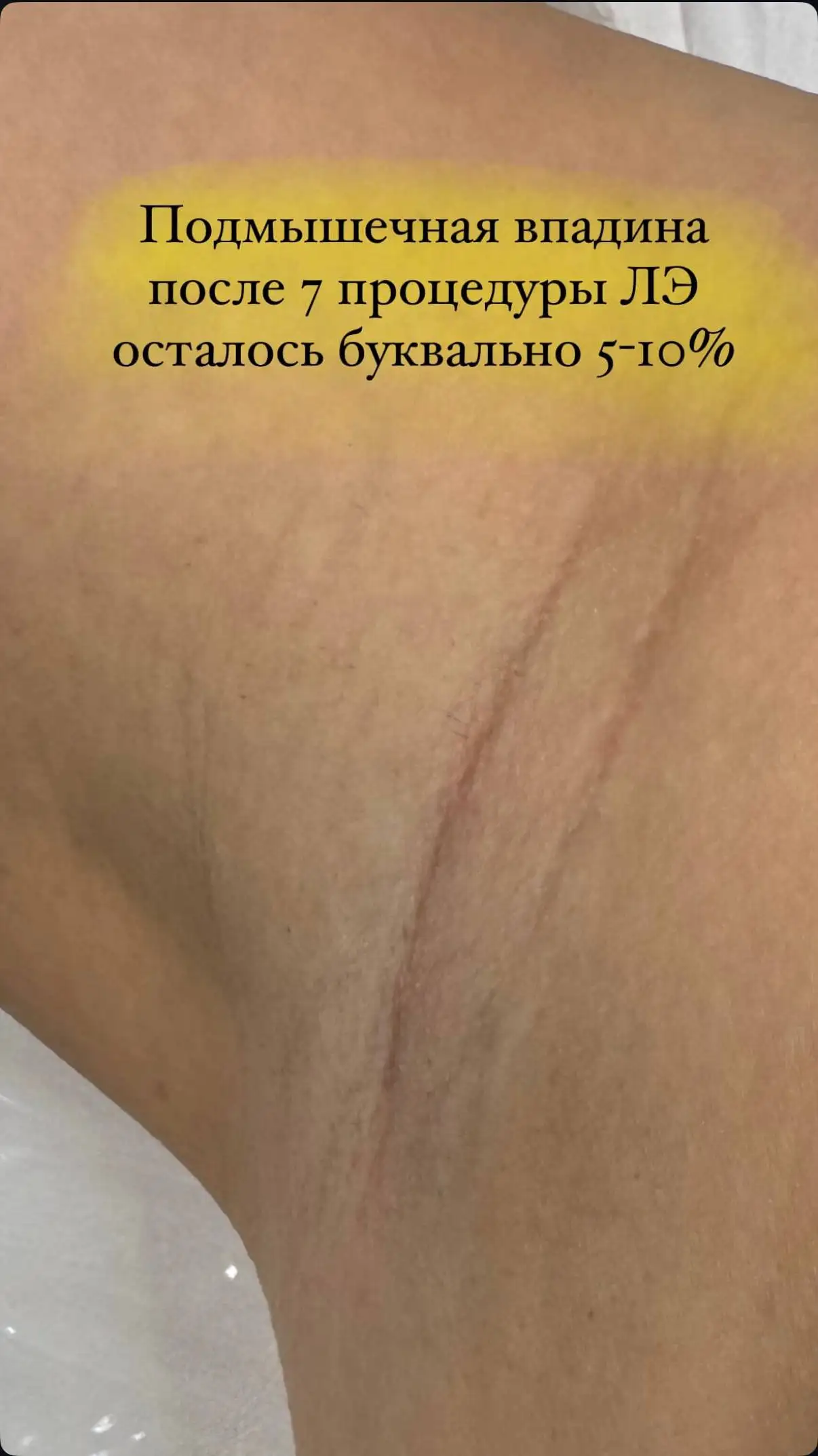 Лазерная эпиляция со скидкой 30% - Эпиляция (Красота и здоровье) в Ульяновск