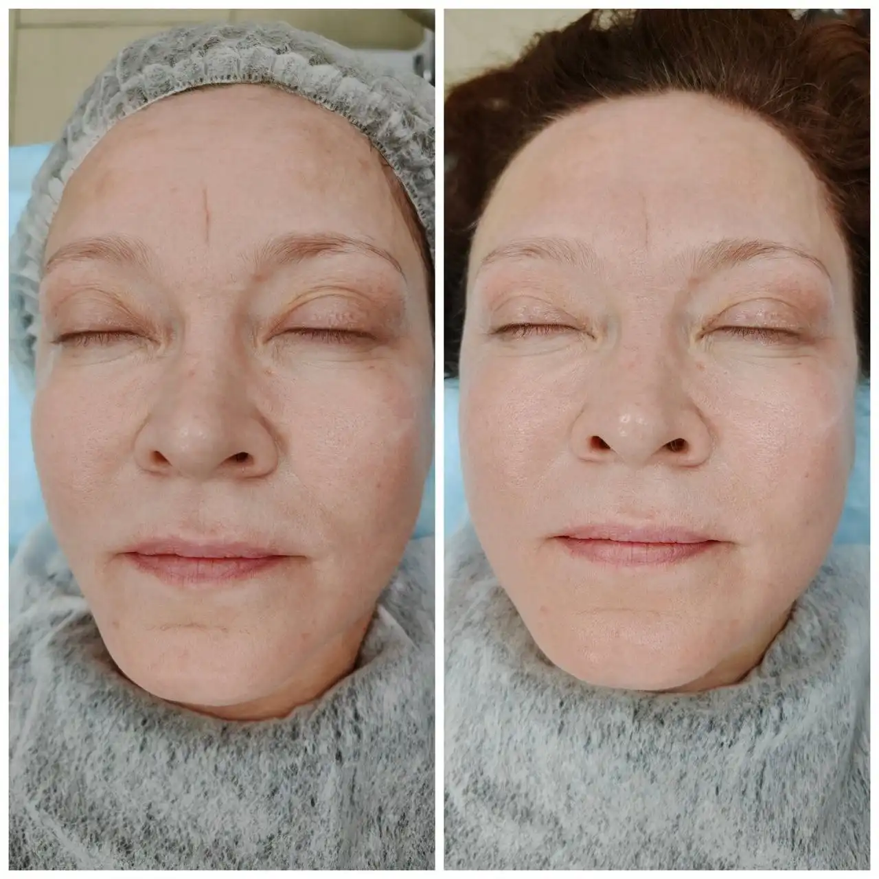 Буккальный массаж лица в Чите